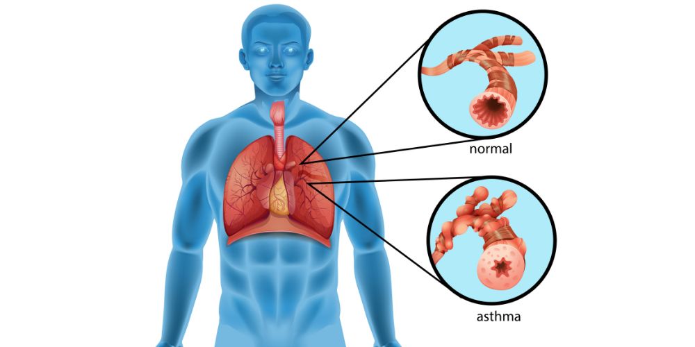 Asthma